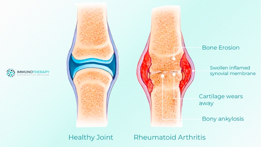 Stem Cell Therapy for Rheumatoid Arthritis RA in Mexico