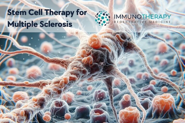 Terapia con células madre para la esclerosis múltiple en México