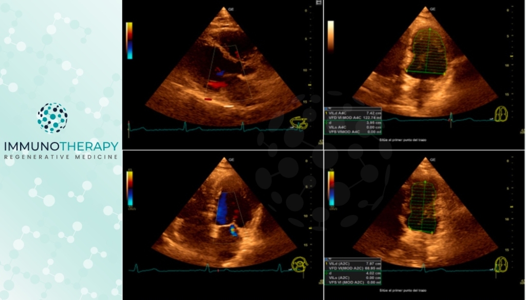 Stem cell therapy for Heart disease - Regenerative Medicine