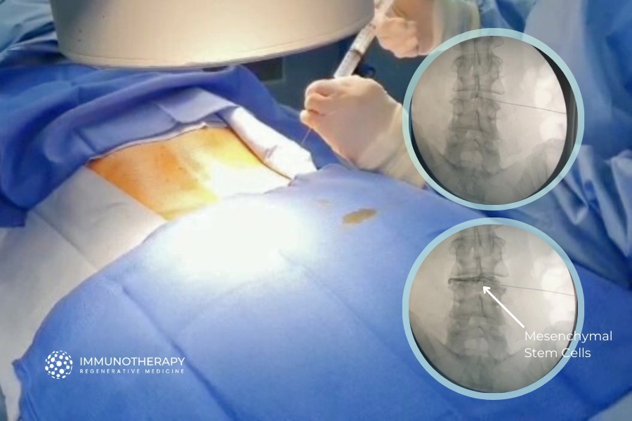 Stem Cell Therapy for Herniated Discs at Mexico