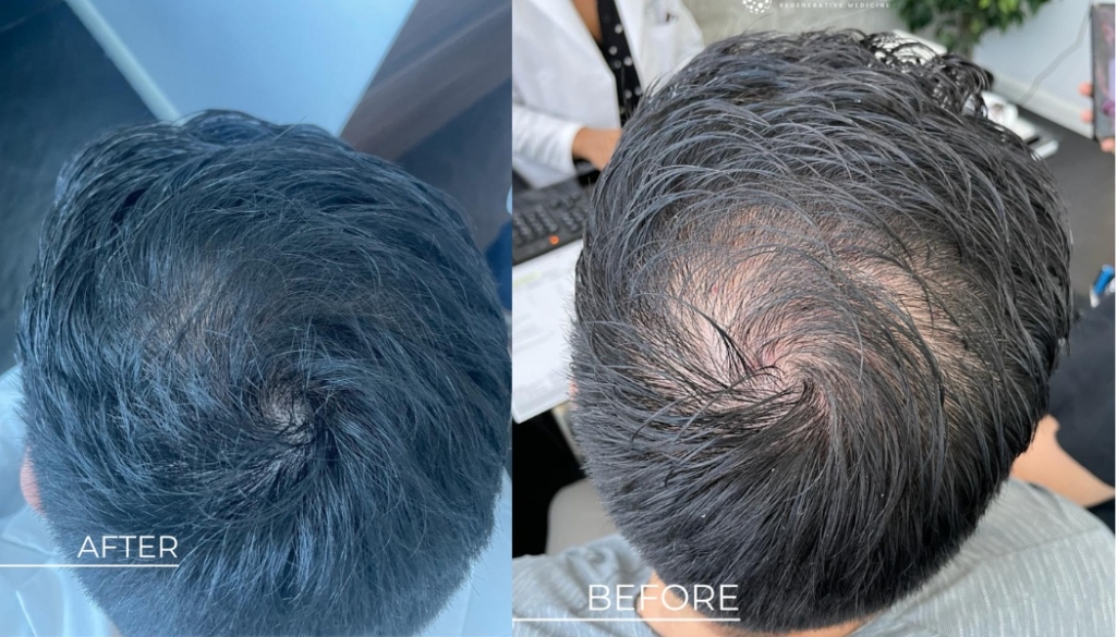 Stem Cell and PRP Treatments for Hair Loss in Mexico