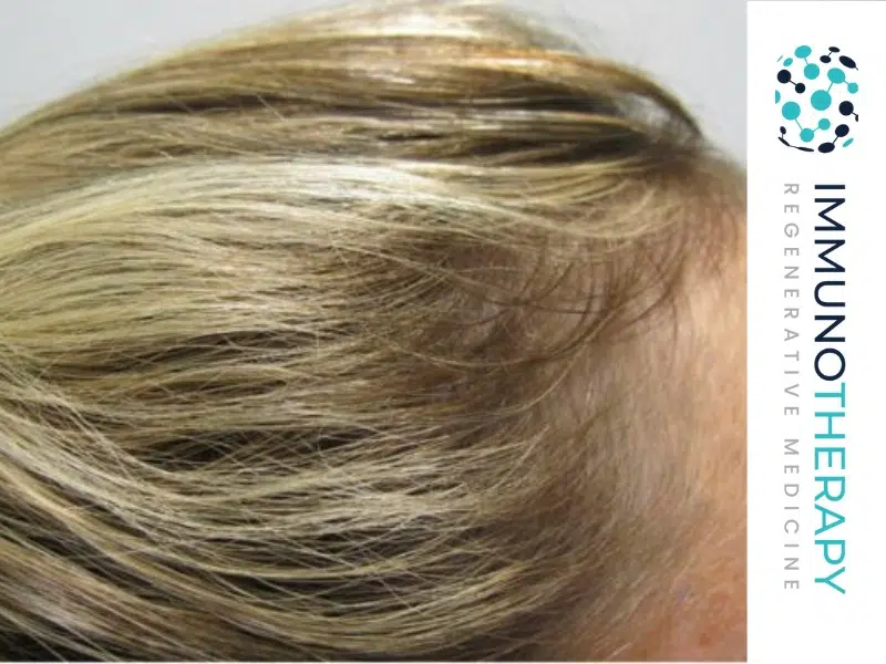 Tratamiento con células madre para la caída del cabello en México para mujeres