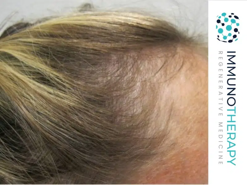 tratamiento con células madretratamiento con células madre para la caída del cabello en mujerestratamiento para la caída del cabello