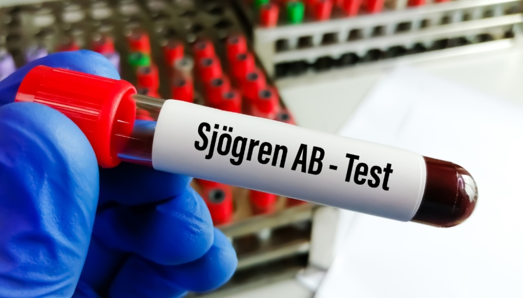 Stem Cell Therapy For sjogrens syndrome