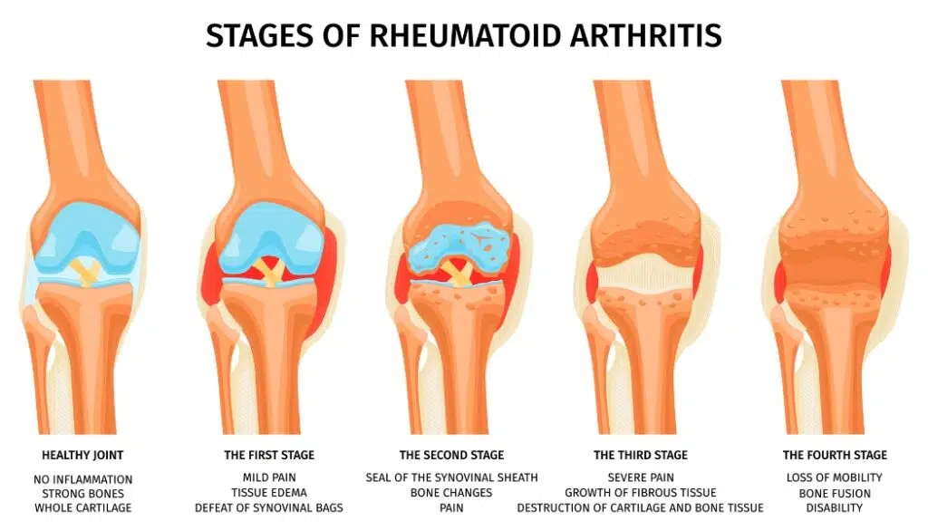 Does stem cell therapy work for rheumatoid arthritis