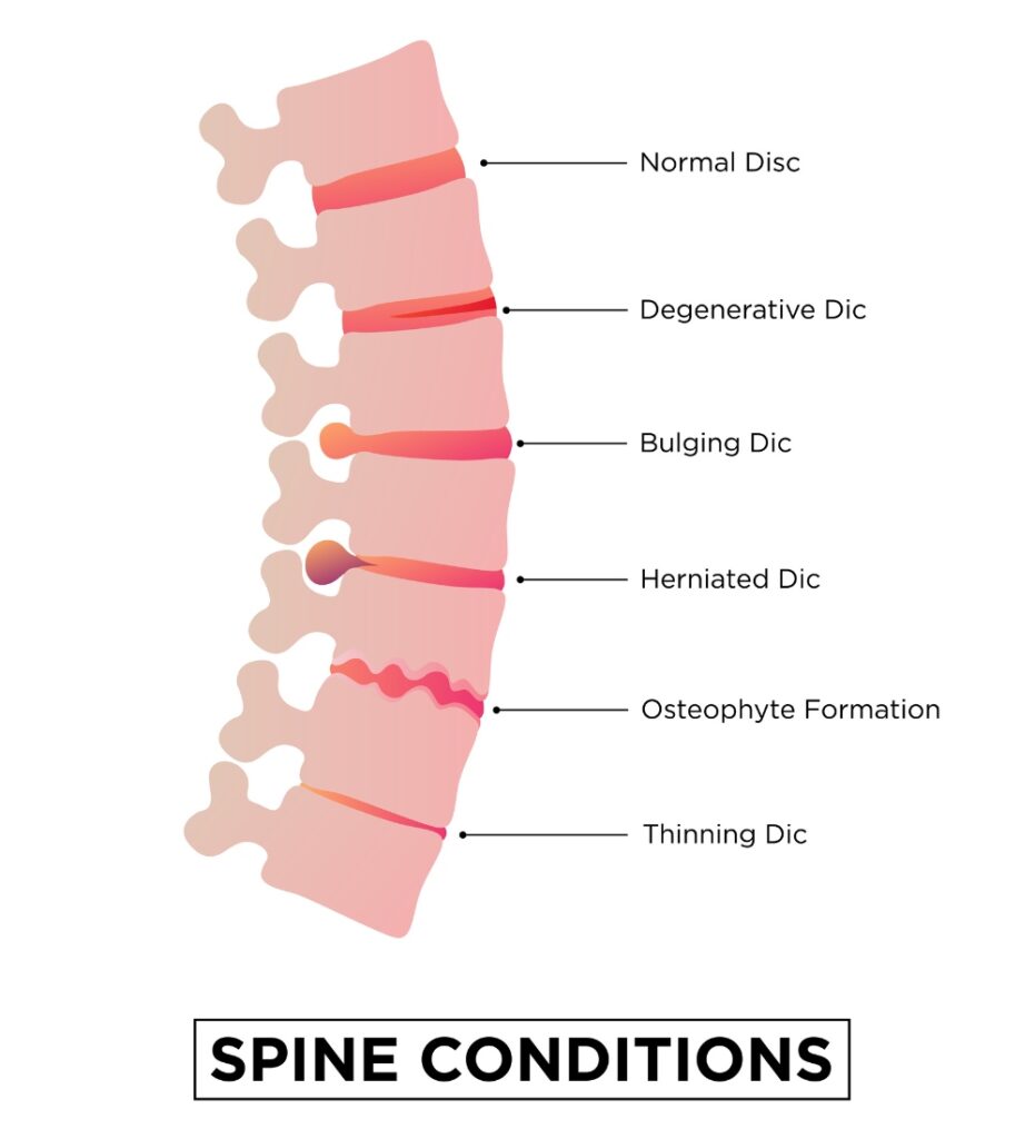 Intradiscal Stem Cell Injections for Low Back Pain mexico