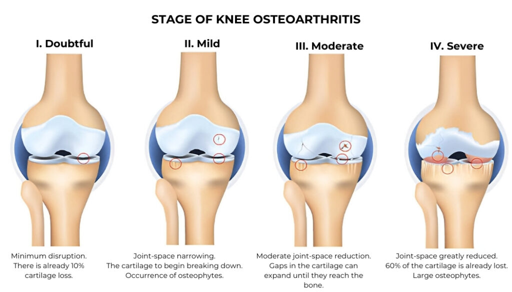 stem cell therapy mexico STAGE OF KNEE OSTEOARTHRITIS