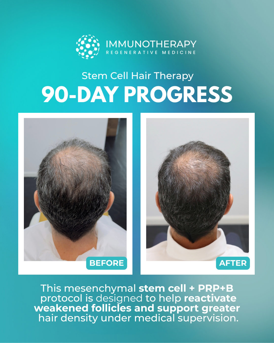 PRP & Stem Cell Therapy For Hair Loss In Mexico | 2026